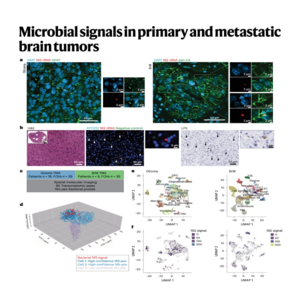 346-Microbial Signals in Primary and Metastatic Brain Tumors