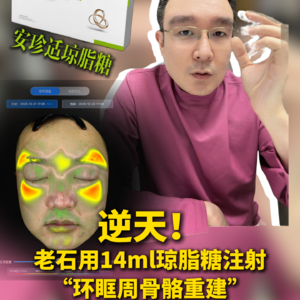 逆天！老石用14ml琼脂糖注射“环眶周骨骼重建”