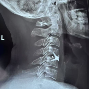 EP19. 那个脖子坏了的男人回来了!小温颈椎手术全纪录