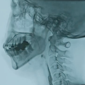 VOL.34康复医学科｜日本医疗剧里重建吞咽功能的治疗我们也可以