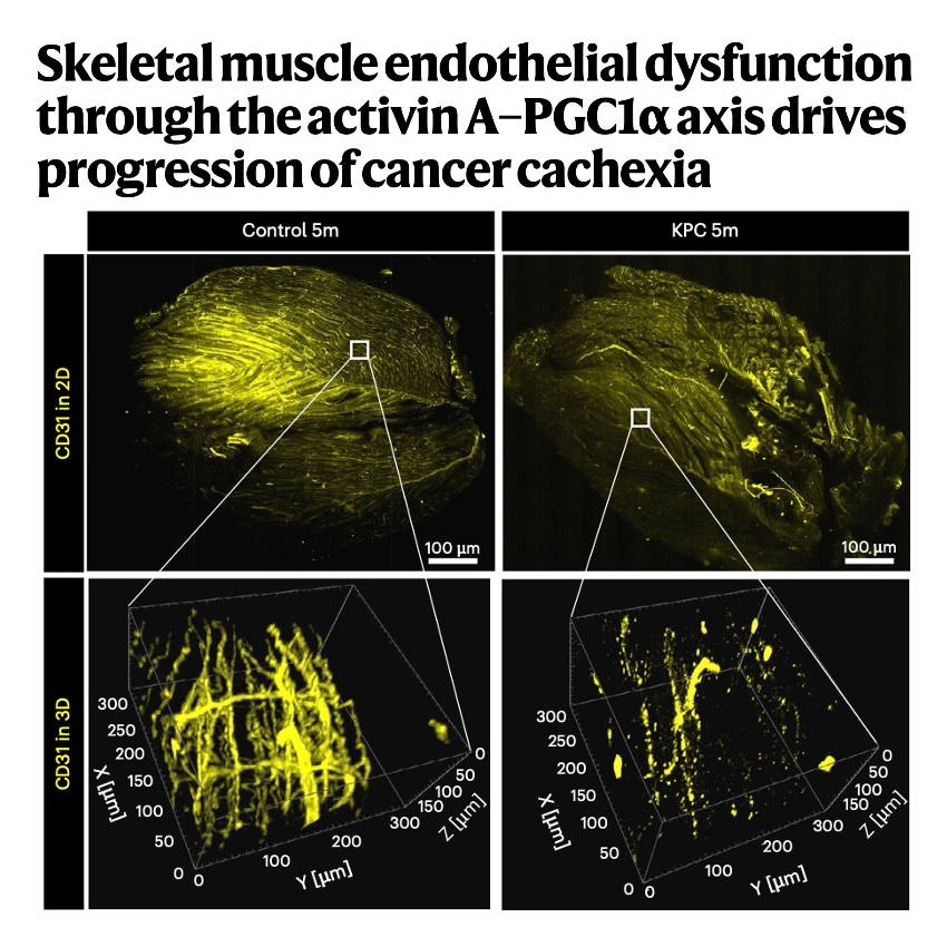 673-Endothelial Dysfunction as a Driver of Cancer Cachexia episode artwork
