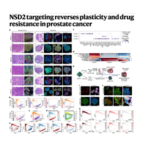 306-NSD2 targeting reverses plasticity in prostate cancer