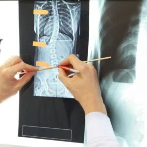 No.72 脊柱侧弯？一起变身侦探评估自检打破焦虑！