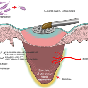 便携穿戴智能微负压。科技改变生活
