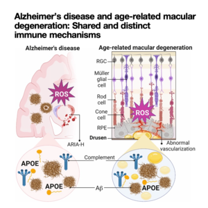047-Alzheimer’s disease and age-related macular degeneration