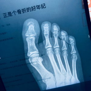 vol.33 三十三岁，正是个骨折的好年纪
