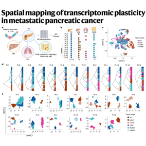 150-Spatial transcriptomic plasticity in pancreatic cancer