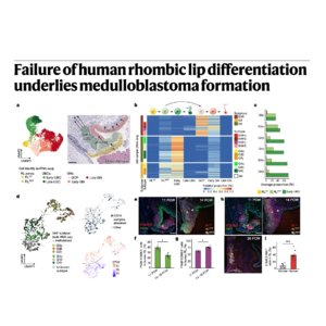 170-CBFA Complex Mutations Drive Medulloblastoma