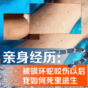 01故事｜1毫克毒液即可致死！他被银环蛇咬伤后死里逃生