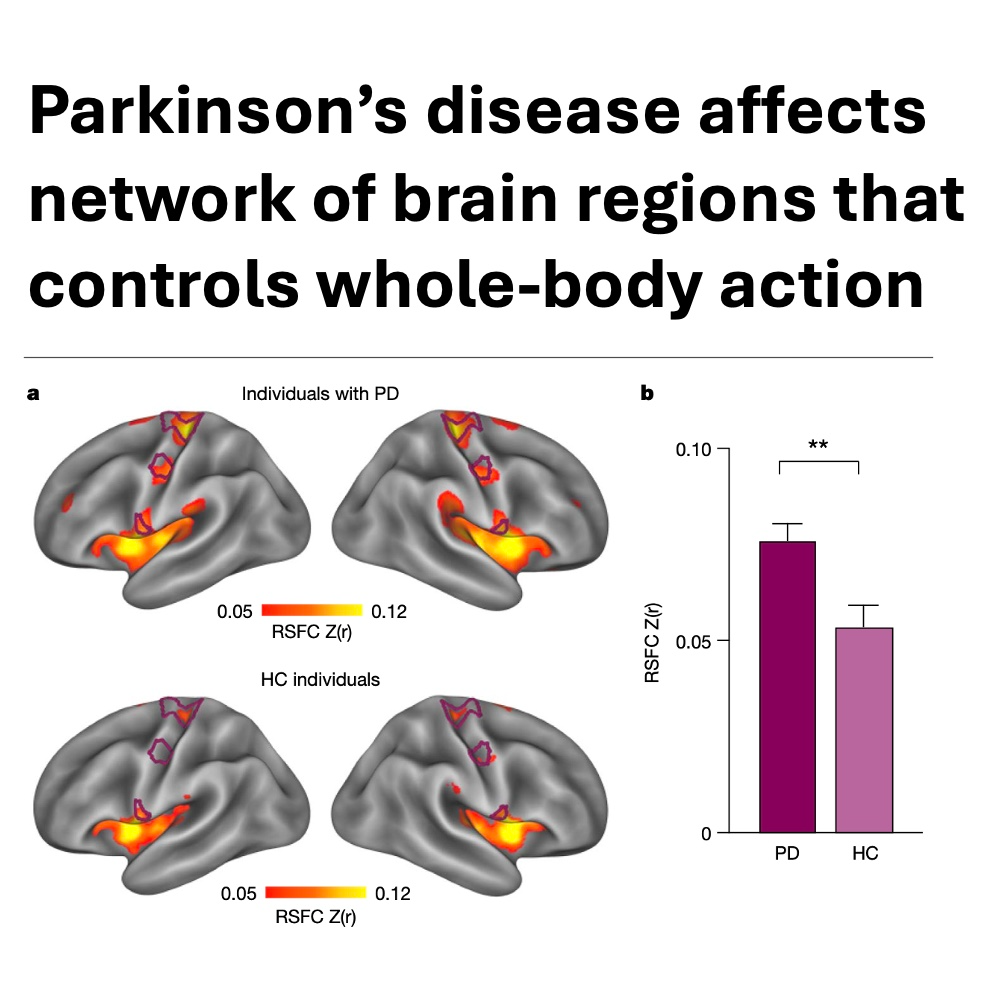 713-Parkinson’s Disease as a Somato-Cognitive Disorder episode artwork