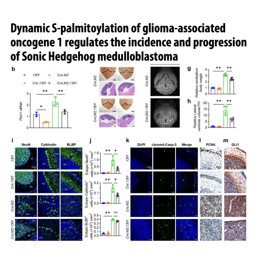 1415-GLI1 Palmitoylation in Sonic Hedgehog Medulloblastoma episode artwork