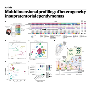 738-Multidimensional Profiling of Supratentorial Ependymomas