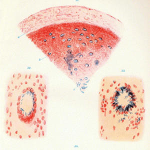 结核病简史：那一天我们抓住了“白色瘟疫”的真凶