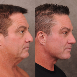 美国科技圈男性掀起面部拉皮风潮