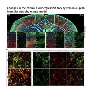1435-GABAergic Inhibitory Dysfunction in Spinal Muscular