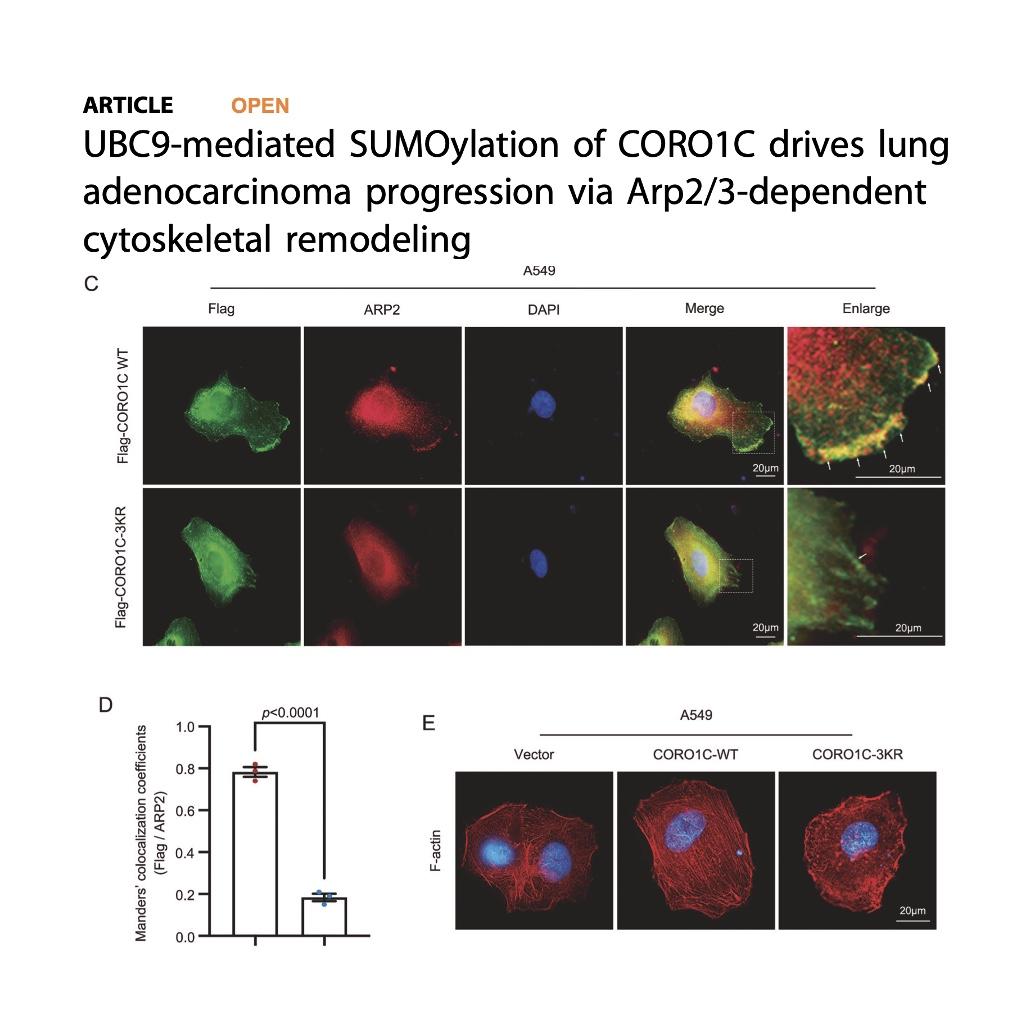 1450-SUMOylation of CORO1C in Lung Adenocarcinoma episode artwork