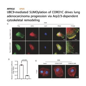 1450-SUMOylation of CORO1C in Lung Adenocarcinoma