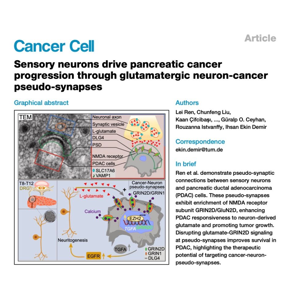 304-Neuronal Glutamate Signaling Hijacks Pancreatic Cancer 304-Neuronal Glutamate Signaling Hijacks Pancreatic Cancer