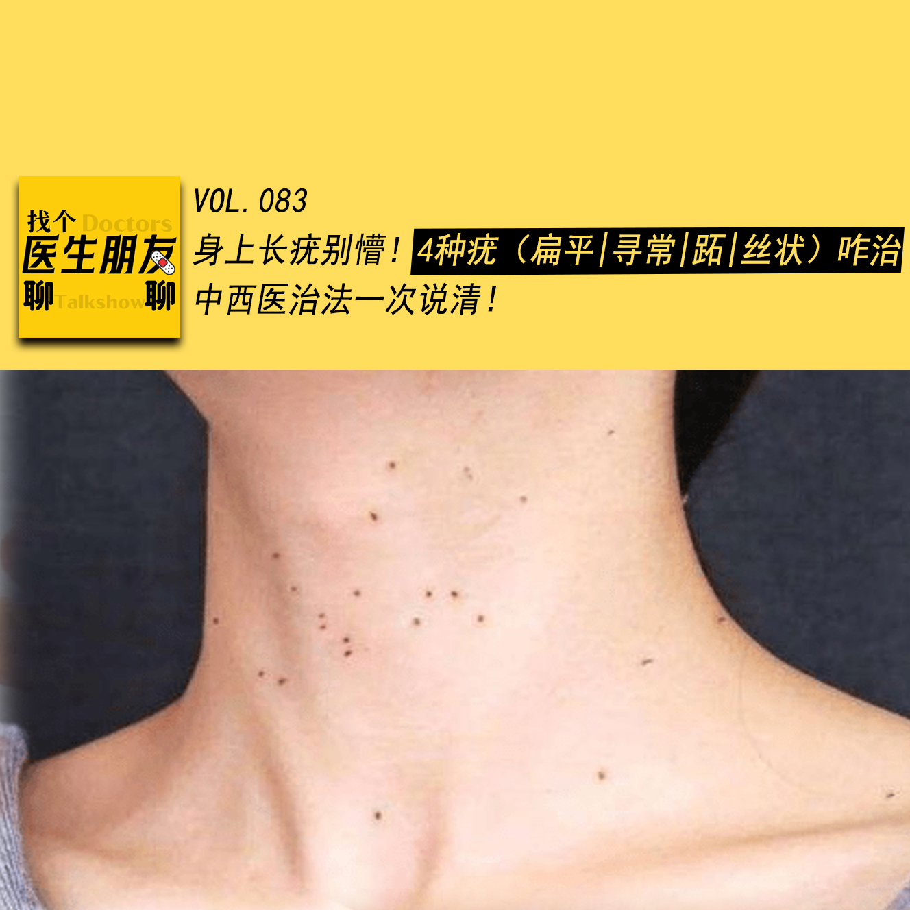 VOL.083身上长疣别懵！4种疣（扁平|寻常|跖|丝状）咋治？中西医治法一次说清！ episode artwork