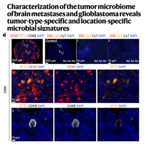 684-Microbial Signatures of Glioblastoma Metastases