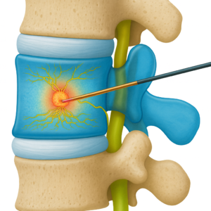 单极 BVN 消融系统