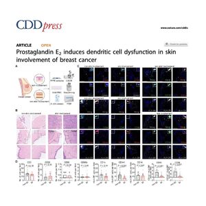 1438-PGE2-Driven Dendritic Cell Dysfunction in Breast Cancer